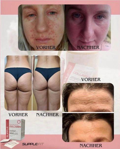SKINAIL COLLAGEN – Nahrungsergänzungsmittel für Haut, Haare und Nägel
